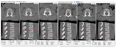 Bone Mineral Density Assessment by Quantitative Computed Tomography in Glucocorticoid-Treated Boys With Duchenne Muscular Dystrophy: A Linear Mixed-Effects Modeling Approach